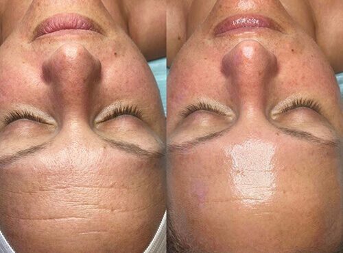 hydrofacial-before-and-after-1-new (1)