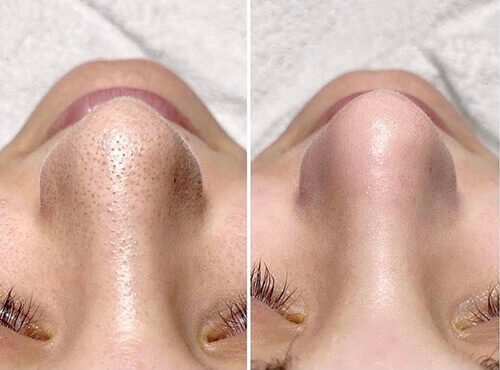 hydrofacial-before-and-after-2-new (1)