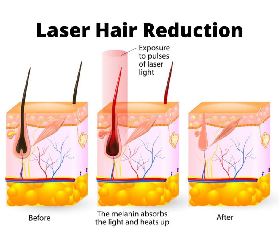 laser-hair-reduction-graphic (1)