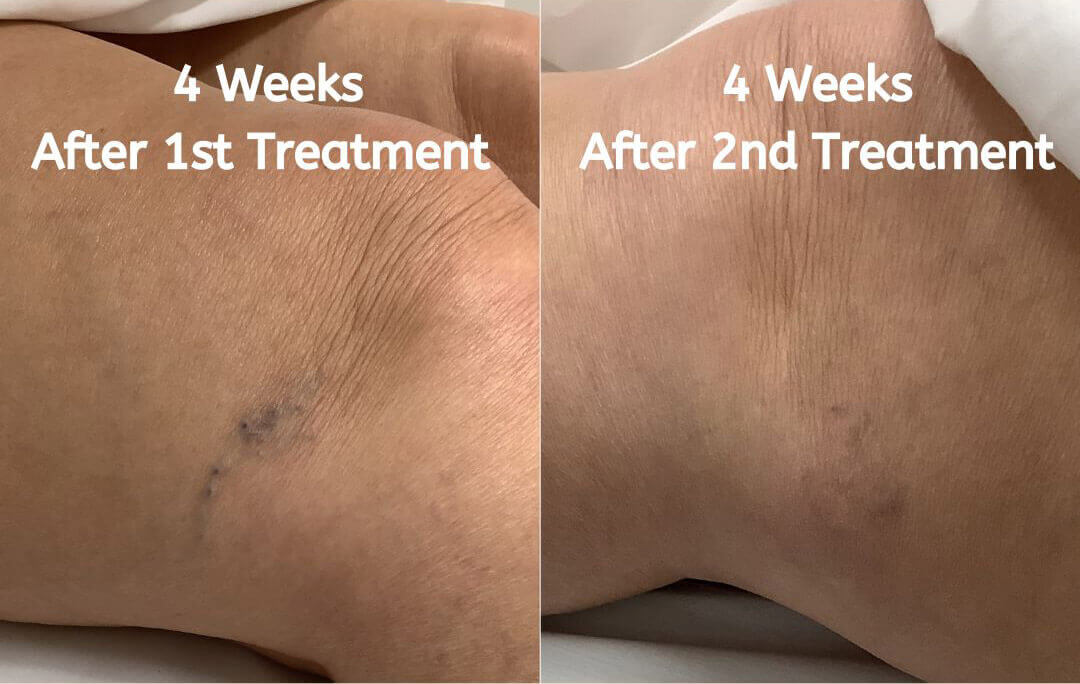 Vein Treatment Belazul